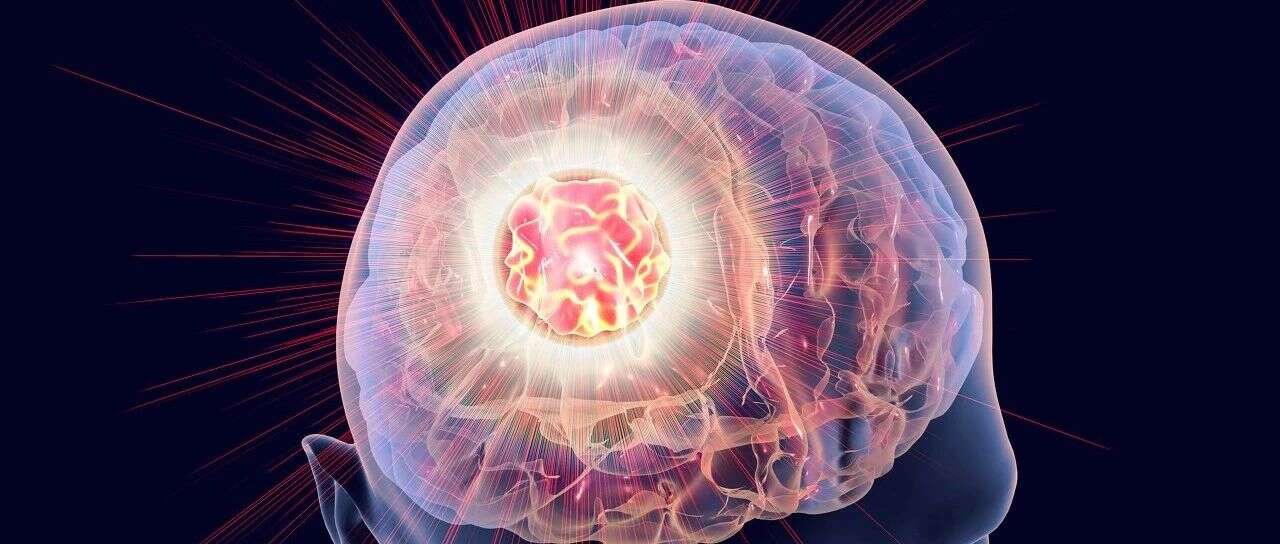 再下一城!Neuro-Oncology:蛋白质组学揭示脑膜瘤临床差异化的分子分型