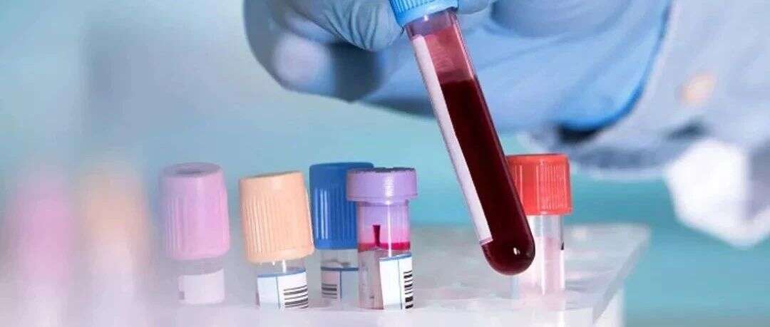MSB:血浆蛋白质组分析揭示新的非酒精性脂肪肝标志物